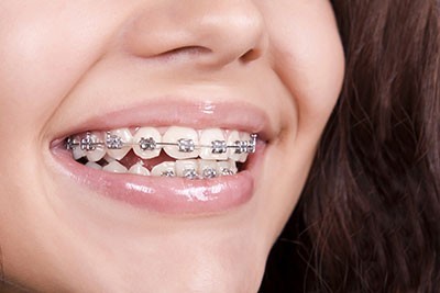در درمان ارتودنسی چگونه دندان حرکت می کند؟