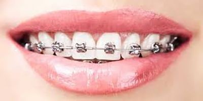 دندان عقل و برگشت نامرتبی دندانها پس از ارتودنسی