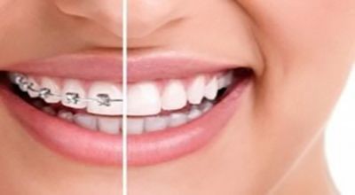 تفاوت دندانپزشک و متخصص ارتودنسی