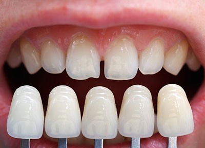 آیا روکش ونیر دندان تعویض می شود؟