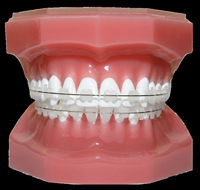 انواع سیم ارتودنسی دندان