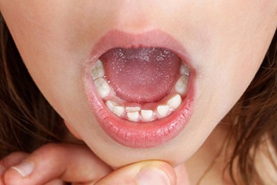 در صورت نیفتادن دندان شیری به صورت طبیعی، چه باید کرد؟