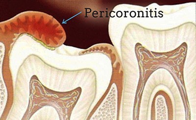 عفونت دندان عقل یا پری کرونیت