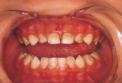 نقص مینای دندان یا هیپوپلازی مینا