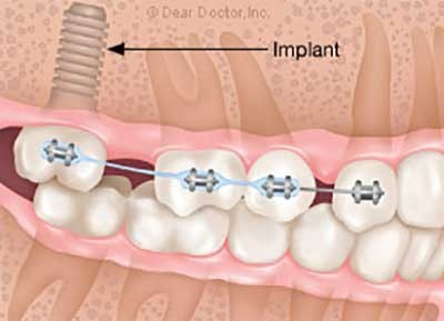 کاشت ایمپلنت دندان پیش از درمان ارتودنسی یا پس از آن؟