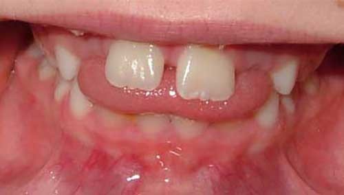 جلو زدن دندانهای جلویی در اثر فشار زبان