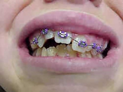 b2ap3_thumbnail_dthumb3_small جلو زدن دندانهای جلویی در اثر فشار زبان 