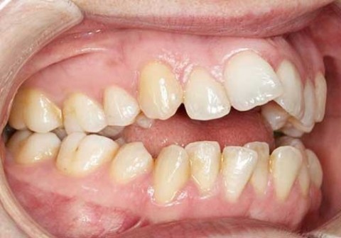 b2ap3_thumbnail_image1-1 جلو زدن دندانهای جلویی در اثر فشار زبان 