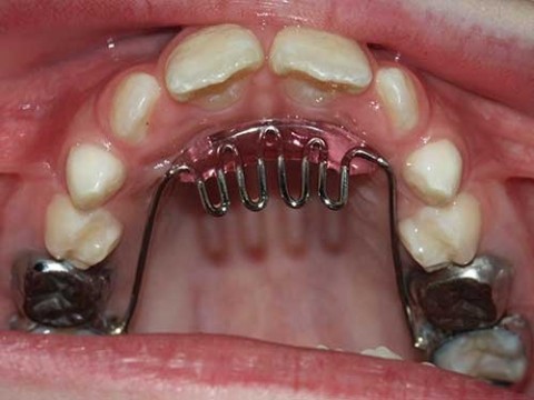 b2ap3_thumbnail_pict00012 جلو زدن دندانهای جلویی در اثر فشار زبان 