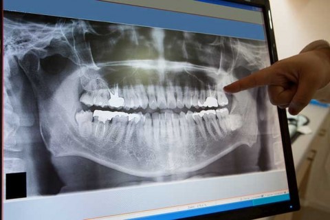 b2ap3_thumbnail_Dental-X-Ray-Sarasota تفاوت بین عکس پرتوی ایکس دیجیتالی و فیلمی