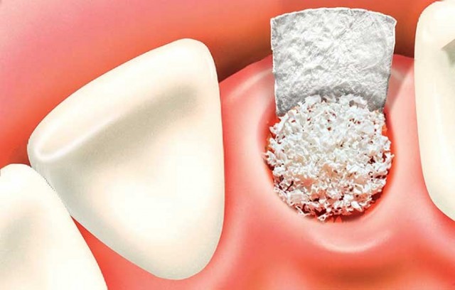 محافظت از حفره دندان