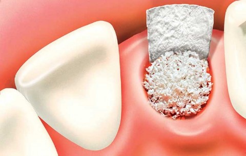 محافظت از حفره دندان