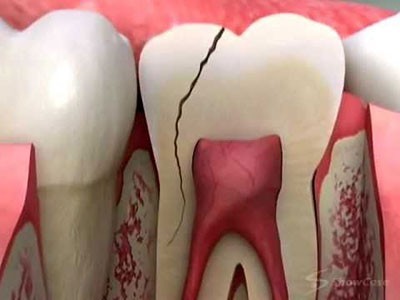 انواع ترک خوردن و شکستگی دندان