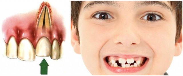 علائم و نشانه های مرگ دندان