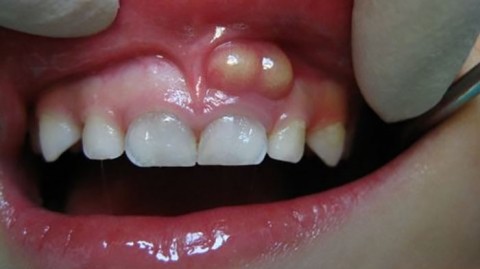 b2ap3_thumbnail_Dental-abscess علائم و نشانه های مرگ دندان 
