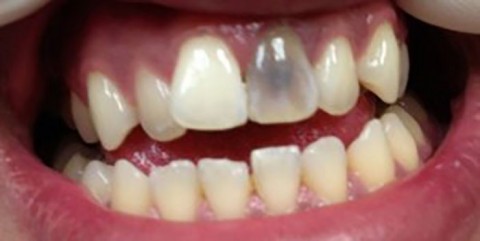 b2ap3_thumbnail_dead-tooth-300x151 علائم و نشانه های مرگ دندان 