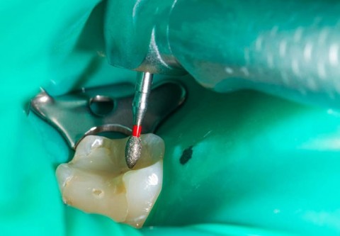 b2ap3_thumbnail_root-canal-dead-tooth علائم و نشانه های مرگ دندان 
