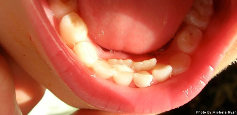 b2ap3_large_shark_teeth_child دندان کوسه ای در کودکان چیست؟ 