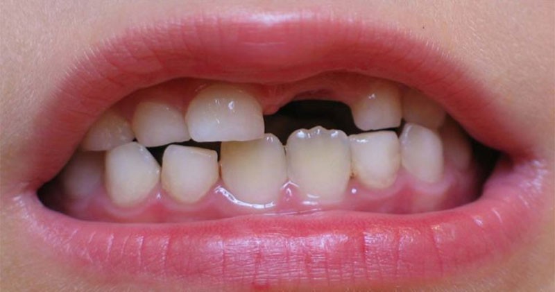 b2ap3_large_3333-3-760x400 اهمیت حفظ و مراقبت از دندان‌های شیری