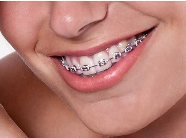 b2ap3_large_braces-poole-orthodontics ارتودنسی شفاف با اینویزالاین