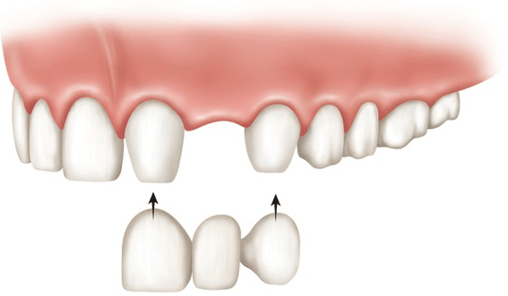 b2ap3_large_1 بریج دندان چیست؟