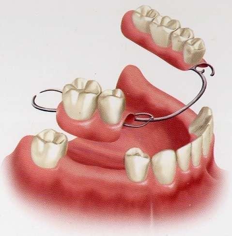 b2ap3_large_222 بریج دندان چیست؟