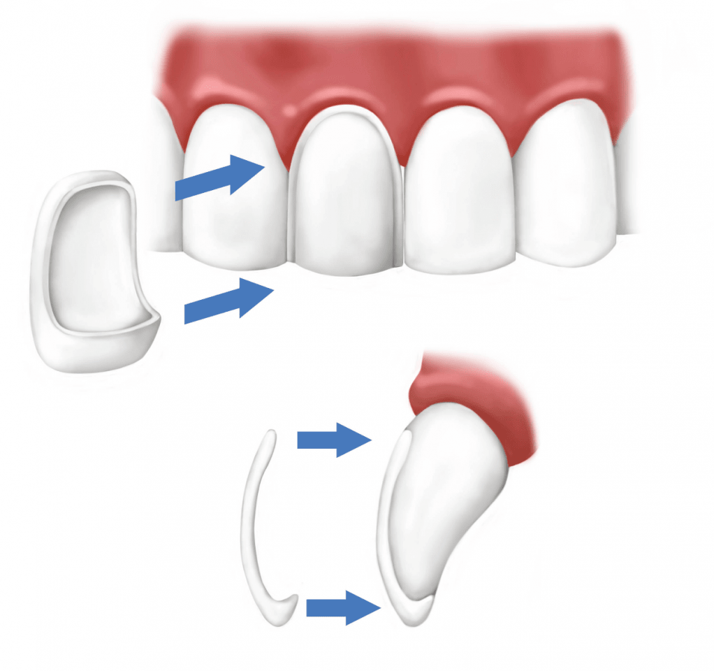 b2ap3_large_3 لمینیت یا ونیر دندان چیست؟ 