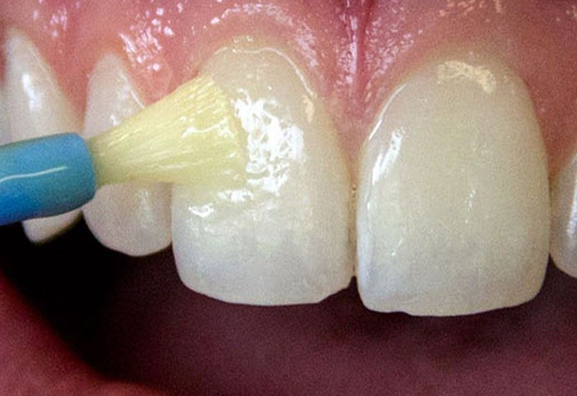 b2ap3_large_Pars_Dental_Houston_Fluoride_Treatment فلوراید درمانی در کودکان