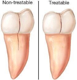 b2ap3_large_cracked-teeth سندرم ترک خوردن دندان