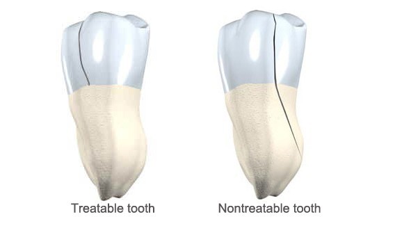 b2ap3_large_cracked-tooth سندرم ترک خوردن دندان