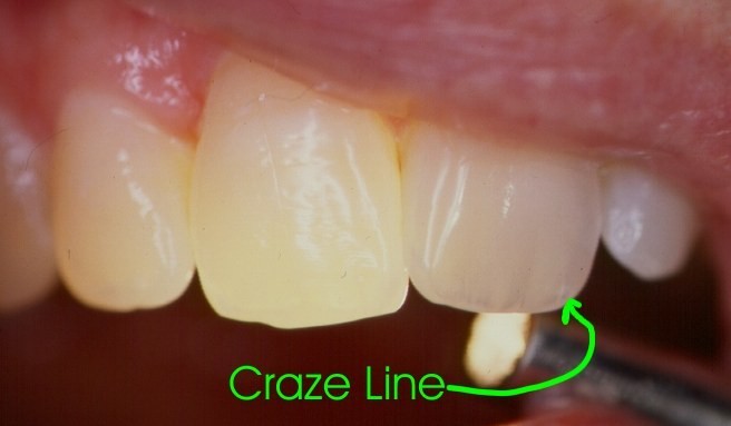 b2ap3_large_crazeline_picture سندرم ترک خوردن دندان