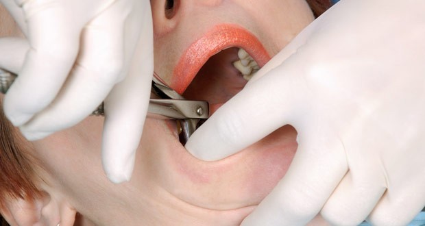 b2ap3_large_tooth-extraction-procedure کشیدن دندان چگونه است؟ 