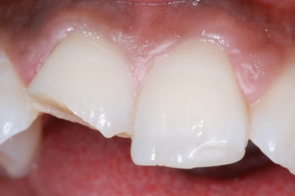 2 روشهای درمان ترک خوردگی و شکستگی دندان