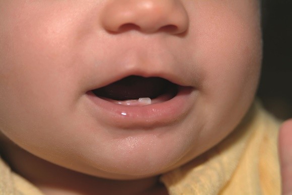 1069693_baby-milk-tooth-erupting-from-gum-close-up-15 دندان درآوردن در کودکان