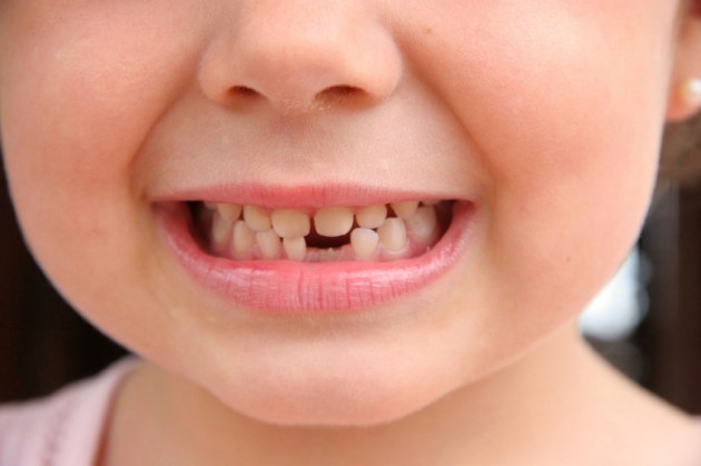 milk-teeth-e145936427435_20180610-073834_1 دندان درآوردن در کودکان