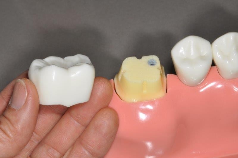 dental-crown1-1 روکش برای چه افرادی مناسب است؟