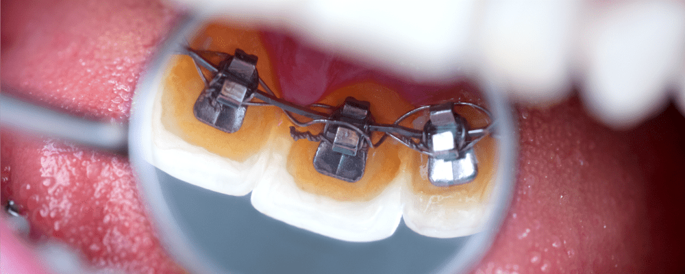 2 ارتودنسی نامرئی: براکت پشت دندانی بهتر است یا اینویزالاین 