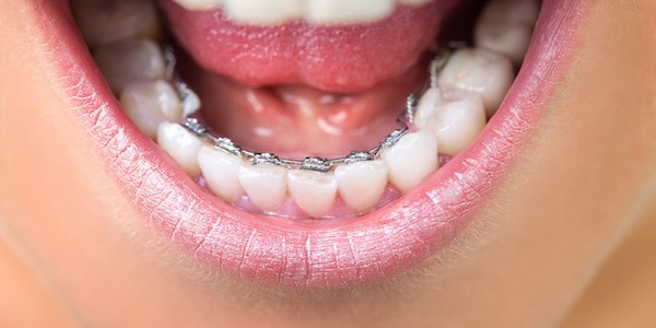 3 ارتودنسی نامرئی: براکت پشت دندانی بهتر است یا اینویزالاین 