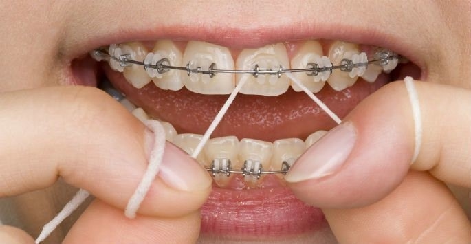 2-2 کلسیم زدایی دندانها و ایجاد لکه های سفید در درمان ارتودنسی