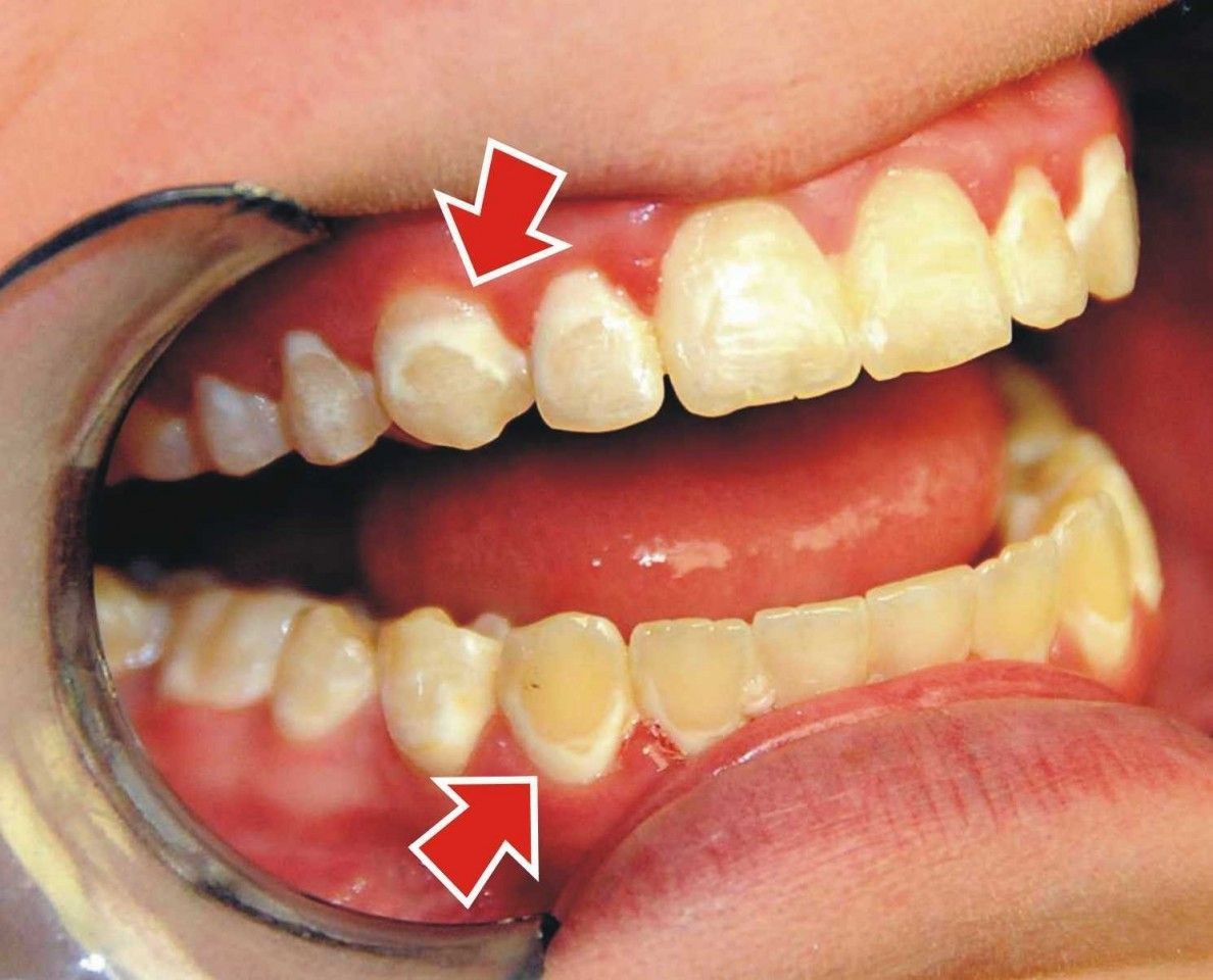 b2ap3_large_1-2 کلسیم زدایی دندانها و ایجاد لکه های سفید در درمان ارتودنسی