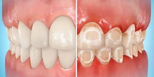 کلسیم زدایی دندانها و ایجاد لکه های سفید در درمان ارتودنسی