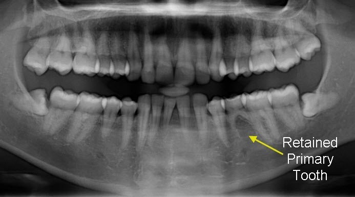 b2ap3_large_2 دلایل نیفتادن دندانهای شیری