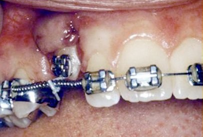 b2ap3_large_impacted-tooth5-full دلایل نیفتادن دندانهای شیری