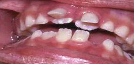 b2ap3_large_impacted دلایل نیفتادن دندانهای شیری