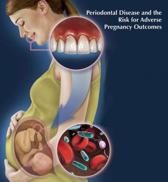 pregnancy-gum-disease