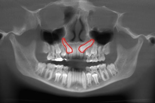 b2ap3_large_xrays5 بیرون کشیدن دندان نهفته از  زیر لثه با ارتودنسی