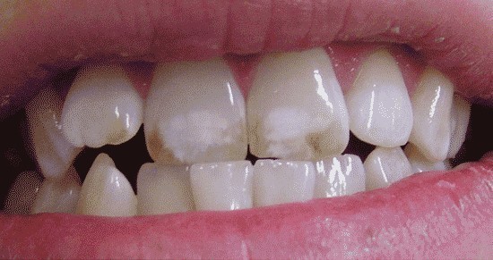 b2ap3_large_oshagh2 مصرف زیاد فلوراید و ایجاد فلوروز دندان