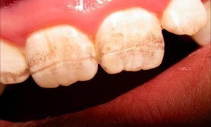 b2ap3_large_ortodonsi2 مشکلات دهان و دندان در بیماری سلیاک