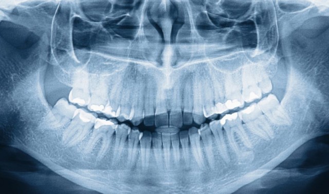 ارتباط از دست دادن چند دندان و اختلال شناختی در مغز