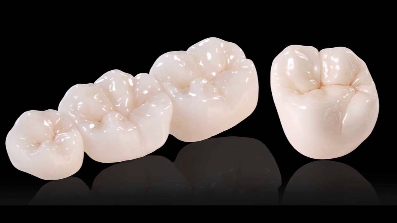 b2ap3_large_4-1 بهترین نوع روکش دندان چیست؟